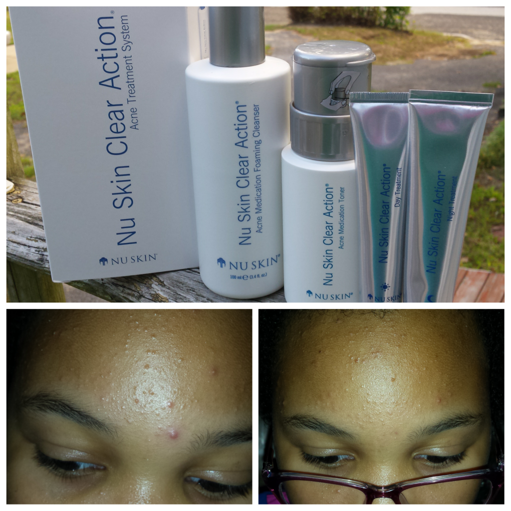 Help Clear Up Acne Using Nu Skin Clear Action Acne